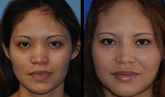 Asian Rhinoplasty before 1239646