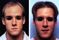 Hair replacement with Fleming/Mayer flap before 143621
