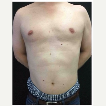25-34 year old man treated with Male Breast Reduction after 3218516