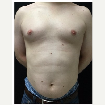25-34 year old man treated with Male Breast Reduction before 3218516