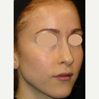 25-34 year old woman treated with Laser Treatment before 3091025
