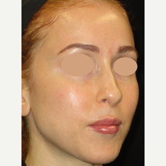 25-34 year old woman treated with Laser Treatment after 3091025