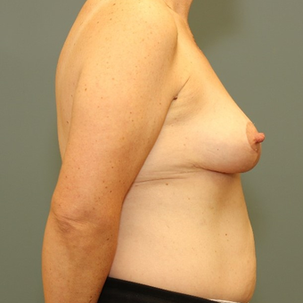 45-54 year old woman requesting a Breast Lift after 3346497