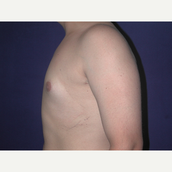 25-34 year old man treated with Male Breast Reduction after 3727267