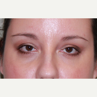 38 year old woman treated with Fat Transfer, transconjunctival lower blepharoplasty, CO2 laser after 3100522