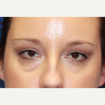 38 year old woman treated with Fat Transfer, transconjunctival lower blepharoplasty, CO2 laser before 3100522