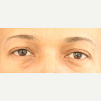 25-34 year old man treated with Eyelid Surgery after 3841977