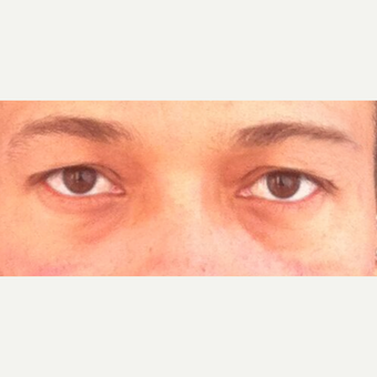 25-34 year old man treated with Eyelid Surgery before 3841977