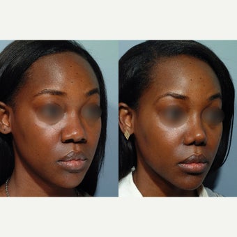 25-34 year old woman treated with African American Rhinoplasty before 1659293