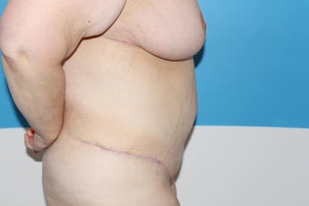 44 yo woman seeking body contouring after gastric bypass after 1365284