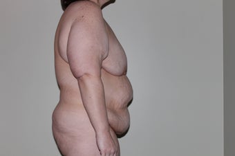 44 yo woman seeking body contouring after gastric bypass before 1365284