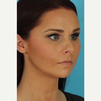 25-34 year old woman treated with Rhinoplasty before 3629216