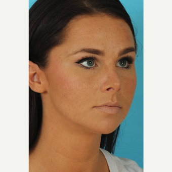 25-34 year old woman treated with Rhinoplasty after 3629216