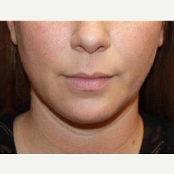25-34 year old woman treated with Kybella after 2526629
