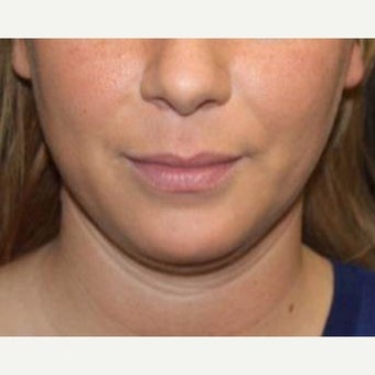 25-34 year old woman treated with Kybella before 2526629