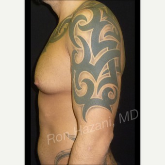 35-44 year old man treated with Male Breast Reduction before 3351882