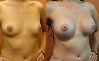 Breast Implants before 974264