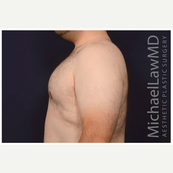 18-24 year old man treated with Male Breast Reduction after 3536546