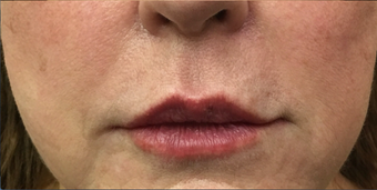 66 year old woman treated with 1 mL of Restylane Silk to the upper and lower lips after 3129576