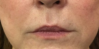 66 year old woman treated with 1 mL of Restylane Silk to the upper and lower lips before 3129576