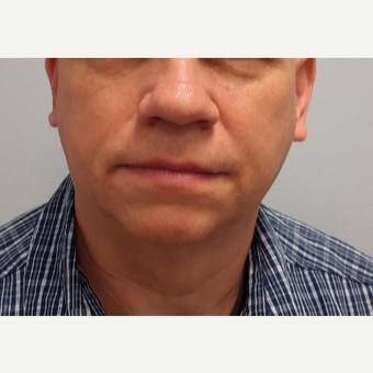 55-64 year old man treated with Ultherapy before 3205449