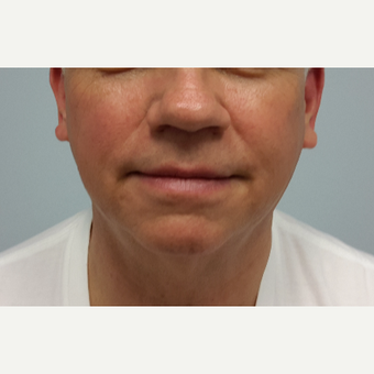 55-64 year old man treated with Ultherapy after 3205449