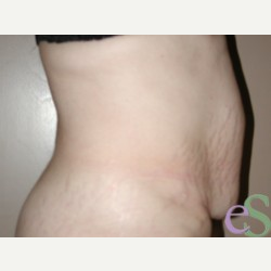 44 year old woman treated with Tummy Tuck before 3484888