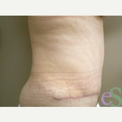 44 year old woman treated with Tummy Tuck after 3484888
