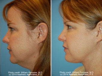 Neck Liposuction before 1389491