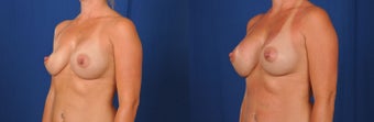 Breast Revision before 1430455