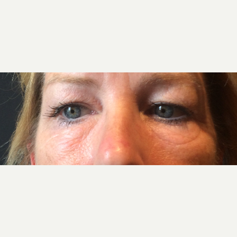 45-54 year old woman treated with Ultherapy before 3460451