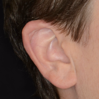 35-44 year old woman treated with Ear Surgery after 3449533