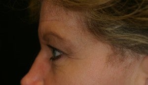 Brow lift followed by an Upper Blepharoplasty before 512712