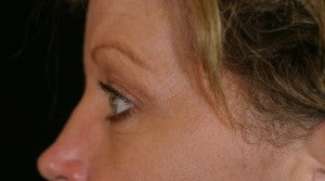 Brow lift followed by an Upper Blepharoplasty after 512712