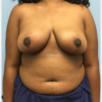18-24 year old woman treated with Breast Reduction after 3050209