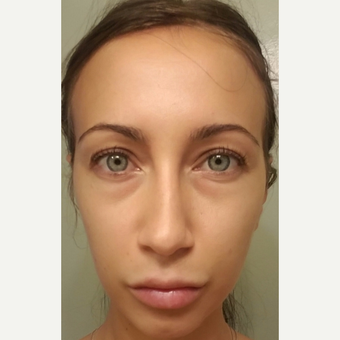 29 year old female, with under eye bags and dark circles, underwent lower blepharoplasty. before 3686663