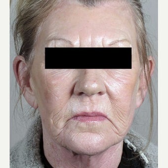 55-64 year old woman treated with Halo Laser after 1909014