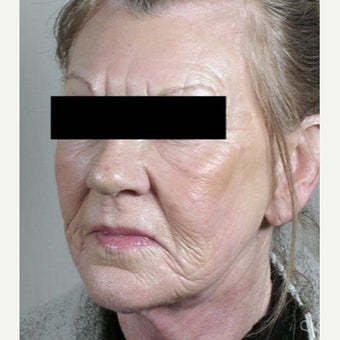 55-64 year old woman treated with Halo Laser 1909014