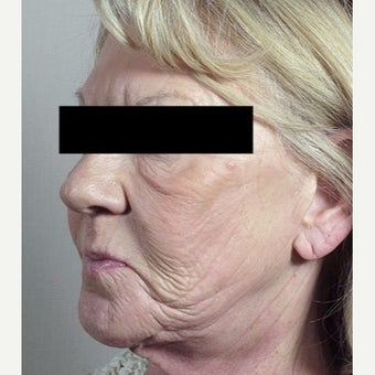 55-64 year old woman treated with Halo Laser 1909014