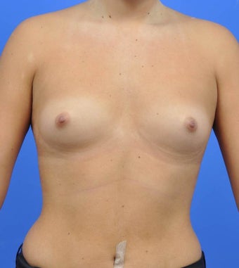 18-24 year old woman treated with Breast Augmentation before 3033882