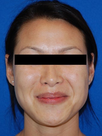 Restylane for Nasolabial Folds before 926686