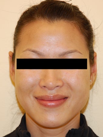 Restylane for Nasolabial Folds after 926686