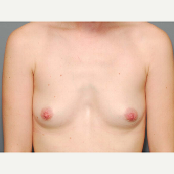 28 y/o Inframammary Sub Muscular Breast Augmentation before 3066136