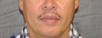 35-44 year old man treated with Lip Lift after 3175804