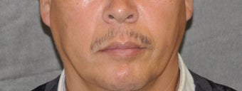 35-44 year old man treated with Lip Lift before 3175804