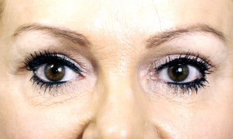 The long term benefits of a browlift in a woman who had the surgery at age 36 and is now 56 years old. after 1425539