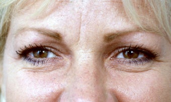 The long term benefits of a browlift in a woman who had the surgery at age 36 and is now 56 years old. before 1425539