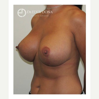 35-44 year old woman treated with Breast Lift with Implants 1617905