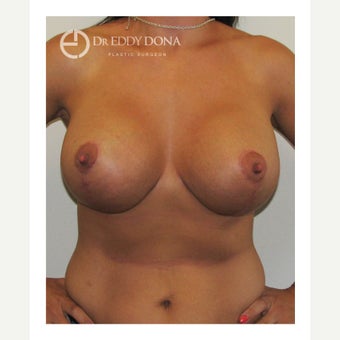 35-44 year old woman treated with Breast Lift with Implants after 1617905