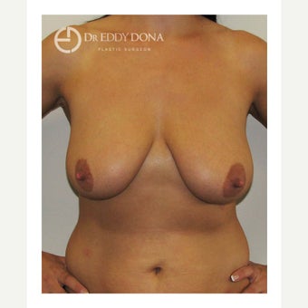 35-44 year old woman treated with Breast Lift with Implants before 1617905